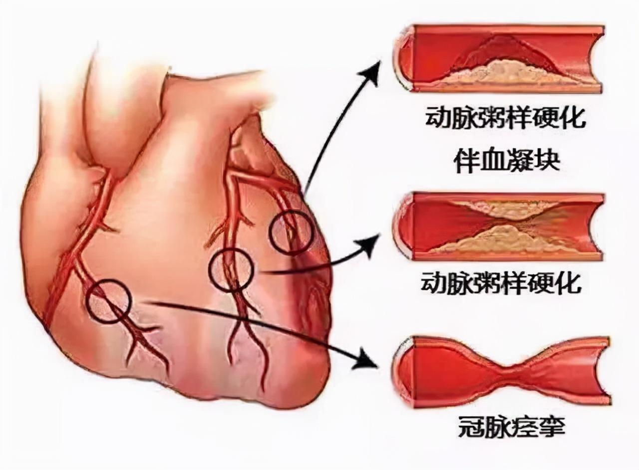 冠心病最新診斷標(biāo)準(zhǔn),冠心病最新診斷標(biāo)準(zhǔn)概述